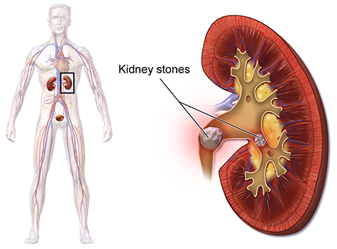 Kidney stone formation