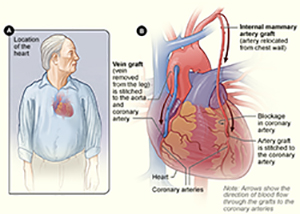 Diagram of coronary artery bypass grafting (CABG) surgery 