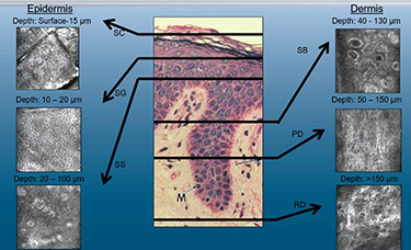 Graphic of epidermal lesions