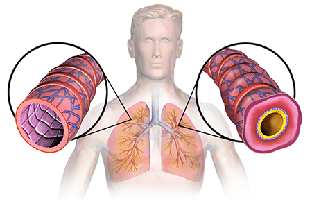 Illustration of asthma's affect on the lungs 