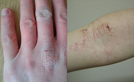 Eczema on the hand and inside of elbow - Wikimedia Commons