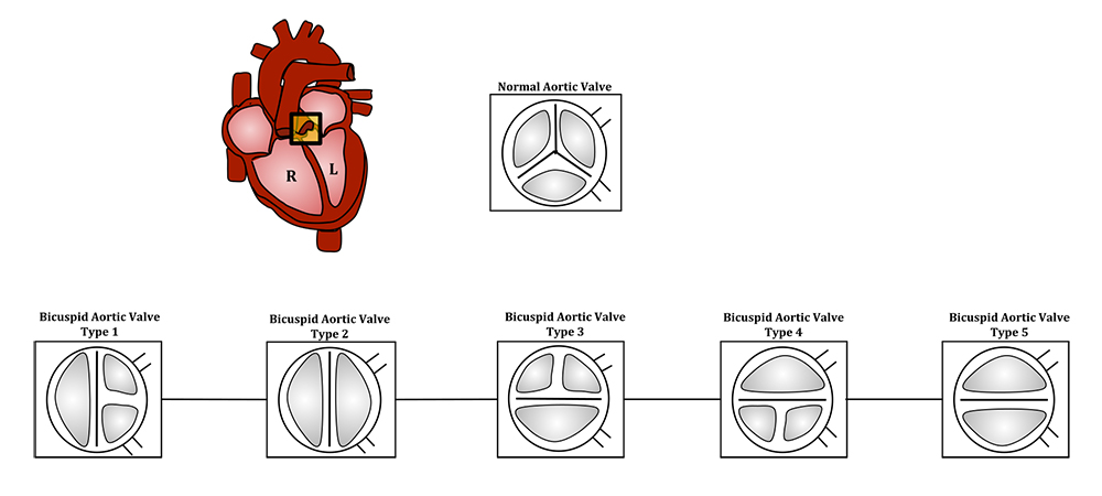 Normal versus bicuspid aortic valves