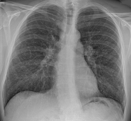 Chest X-ray of sarcoidosis nodules (Courtesy Mikael Häggström via Wikipedia)