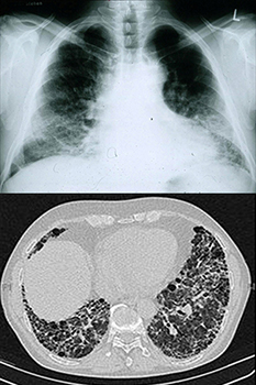 A chest radiograph of a patient with idiopathic pulmonary fibrosis (above) along with a high resolution computed tomography scan (below) of the chest of an IPF patient that, in dark areas, shows peripheral basal pattern of coarse reticulation with honeycombing. [Credit: Wikipedia/IPFeditor]