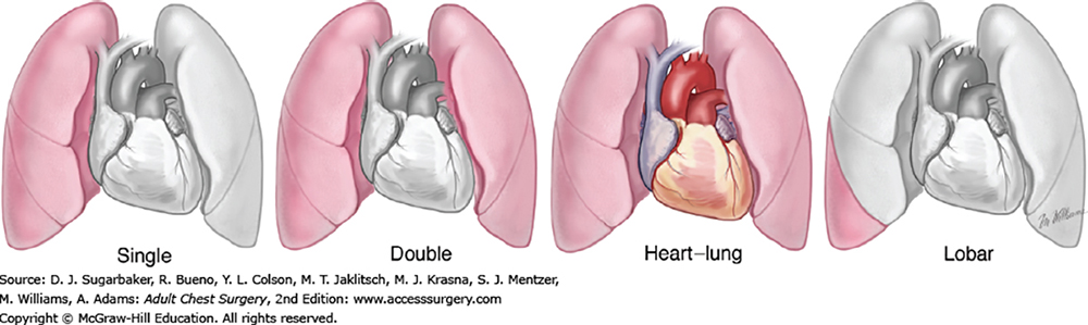 Lung Transplant Types, "Adult Chest Surgery" (Figure 108-1) - https://accesssurgery.mhmedical.com/content.aspx?sectionid=72434315&bookid=1317
