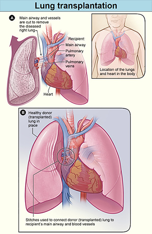 NHLBI illustration of lung transplant process