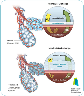 [Pulmonary Fibrosis Foundation graphic illustrating what happens in the lungs due to interstitial lung diseases characterized by inflammation, scarring or both. There are more than 200 types of this disorder.]