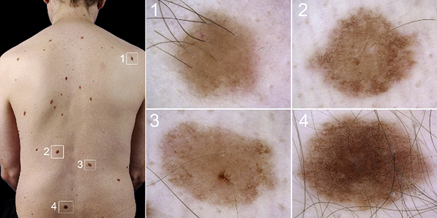 Clinical image of a patient with dysplastic nevus syndrome. Dermatoscopically (1–4), it can be seen that some of the large dysplastic nevi, or atypical moles, are congenital nevi by the presence of terminal hairs. (Credit: Dermatologic Clinics – https://www.ncbi.nlm.nih.gov/pubmed/24075546)