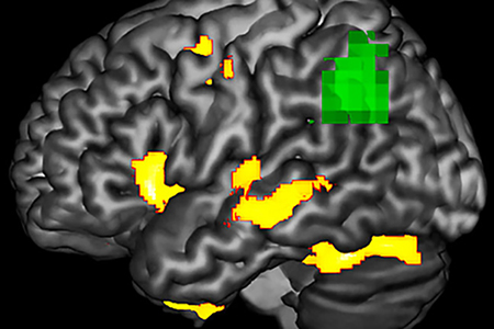 This image highlights areas in a brain with PPA during a language task where researchers observed functional abnormality (green) and structural degenerating (yellow). The green areas may be at-risk or dysfunctional, even if the neurons are not yet dead. (Image courtesy of Dr. Aneta Kielar)