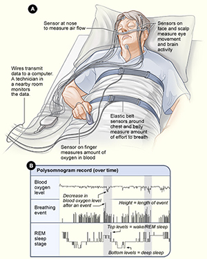 Graphic of typical sleep study setup from NHLBI/NIH