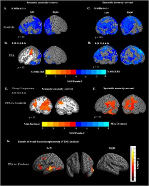 Figure 3 of March 2018 article in NeuroImage: Clinical