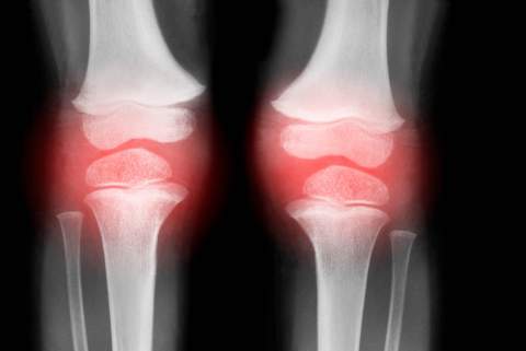 [X-ray image of knees with red marking pain spots - courtesy of Getty Images]