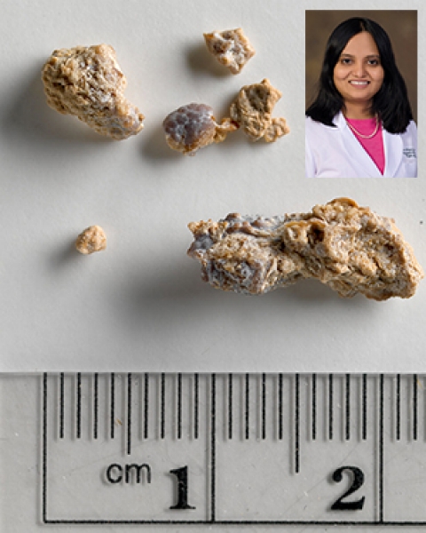Image of kidney stones with Dr. Sireetha Koppula