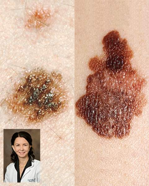 Moles, melanoma and Dr. Clara Curiel-Lewandrowksi, of the UA Skin Cancer Institute