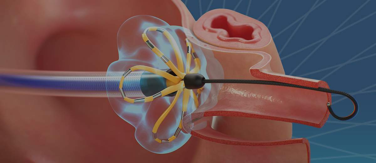 [A Boston Scientific illustration of how the catheter device in the FARAPULSE Pulsed Field Ablation System functions treating tissues in the heart.]