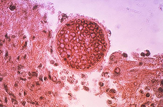 Coccidioides spores that cause the fungal respiratory illness Valley fever - CDC